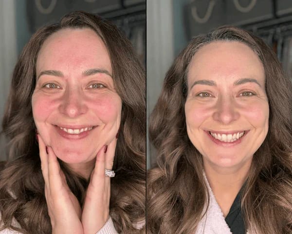 Customer photo review of PDRN Piel más firme y con menos lineas visible en 14 días — sin agujas