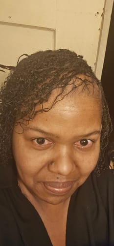 Close-up of a reviewer showing hair starting to fill in at the hairline while using Rennora Hair Growth Serum.