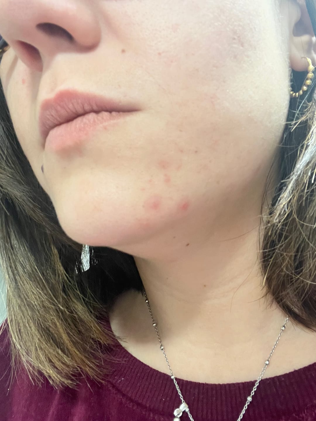 Customer photo review of MIRACLE H -  ÁCIDO HIPOCLOROSO - TÓNICO ANTIBACTERIANO Y ANTIINFLAMATORIO