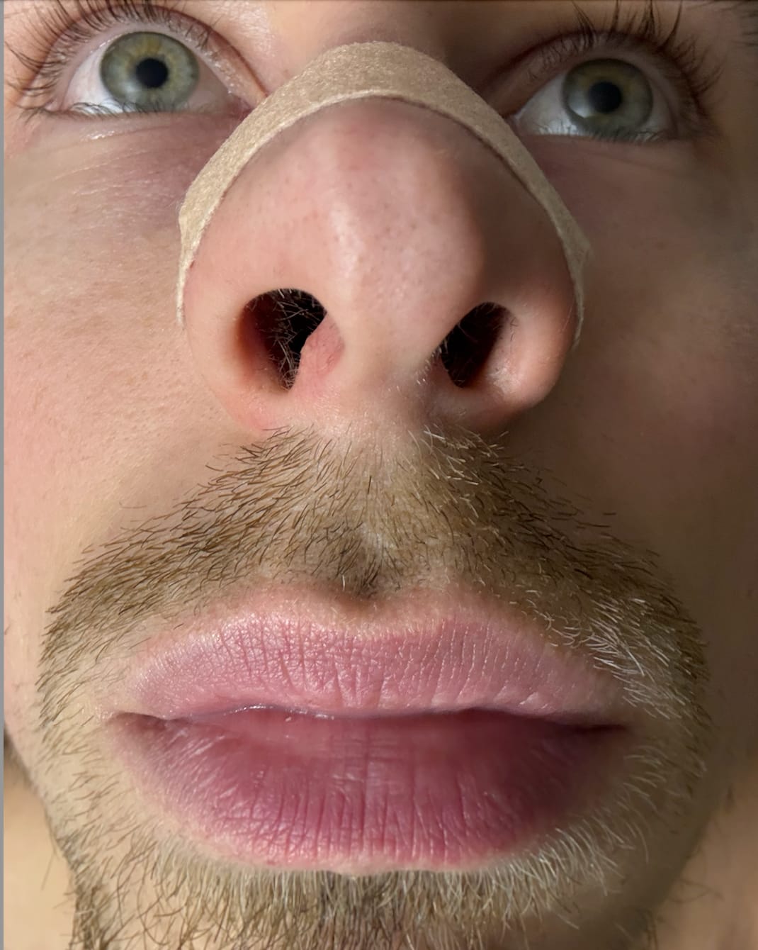 Customer photo review of nordicalm™ Nasal Strips