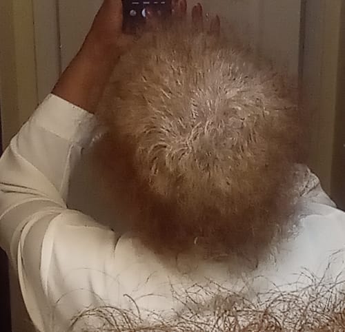 Close-up: Reviewer's thin, light-colored hair at the crown, showing results from Rennora Hair Growth Serum.