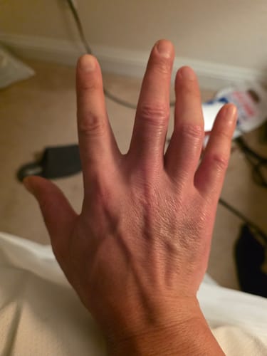 Customer photo review of EczPro - Probiotics for Eczema, Natural Remedy, 13 Histamine-Safe Strains, Allergen-Free Formula
