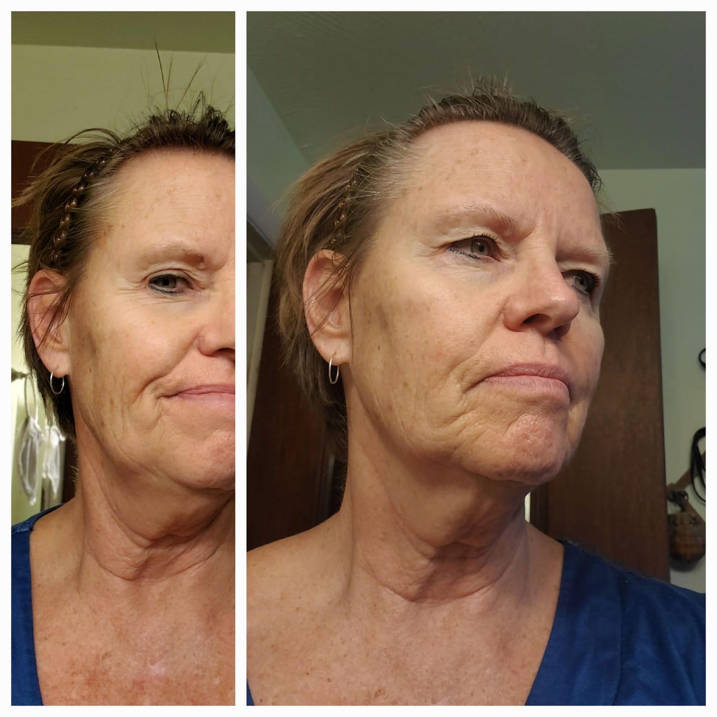 Customer photo review of Koriderm™ Time Reverse (All-In-One) *