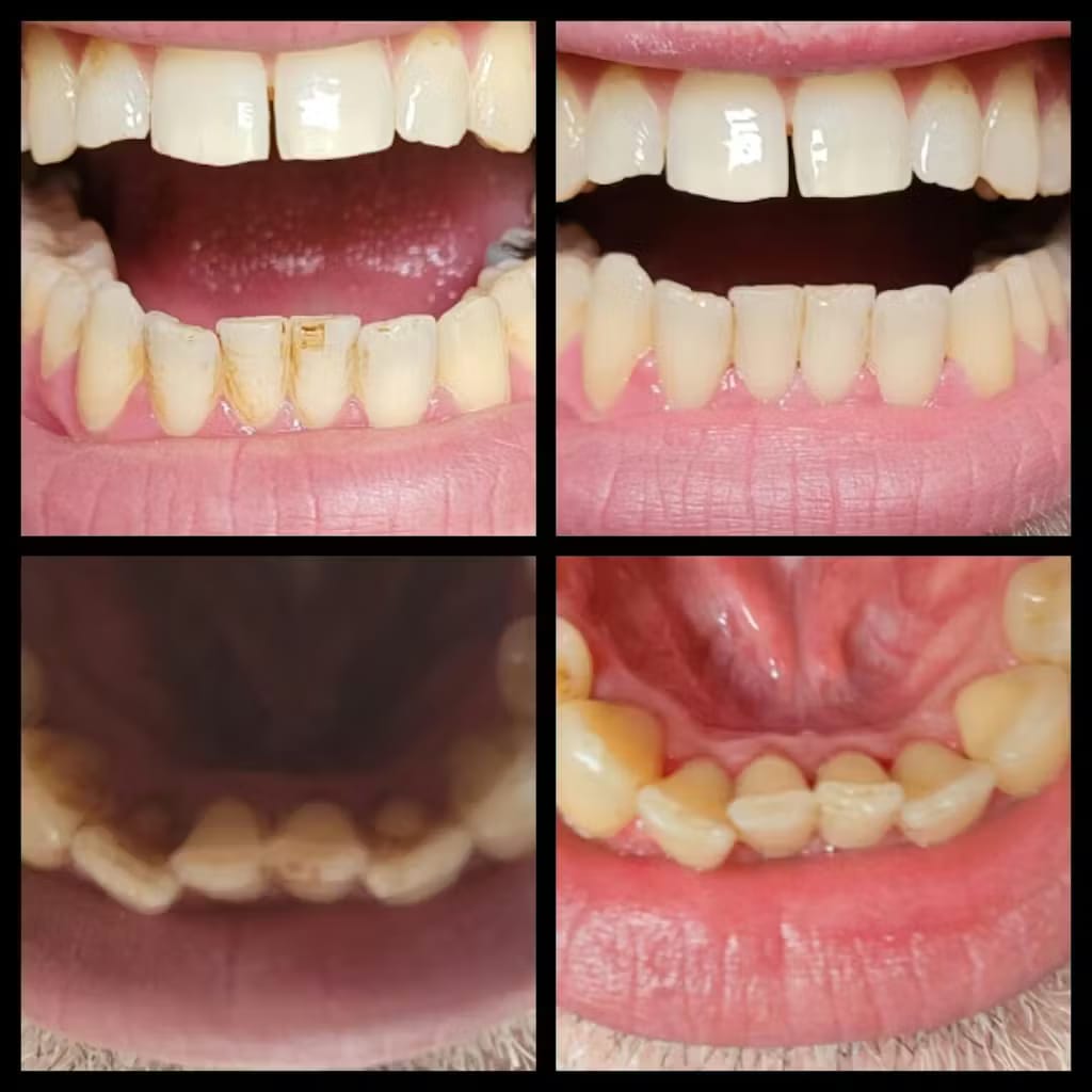 Customer photo review of Zaluna ultrahangos fogtisztító