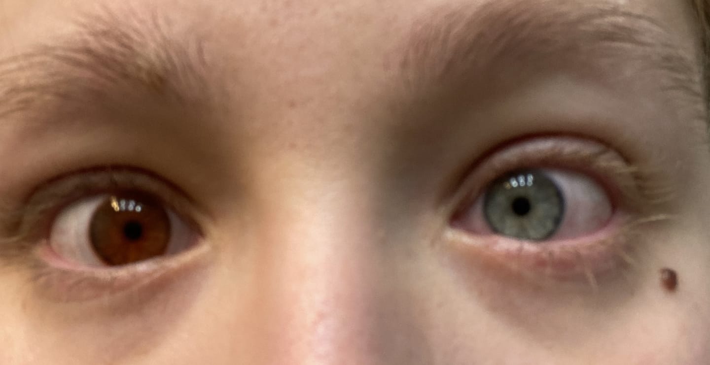 Customer photo review of Eyeling FL41 light sensitivity contact lenses