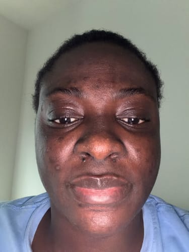 Reviewer's face showing gradual improvement after using the Turmeric Fade & Glow Bar.