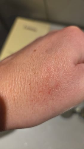 Nahaufnahme der geröteten und gereizten Hand eines Kunden nach der Anwendung des Mikro Infusions Kits.