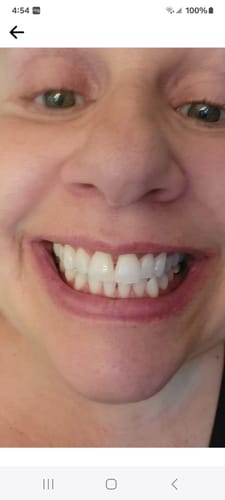 Customer photo review of EvenSkyn® Venus: Advanced Eyelid Anti-Aging Device