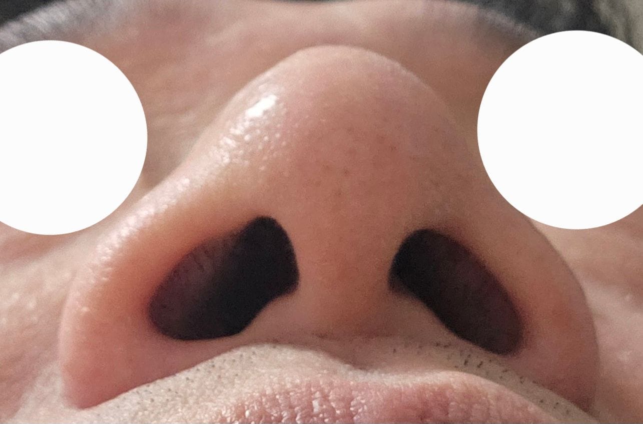 Customer photo review of Docamark™ Sporcu Burun Açıcı