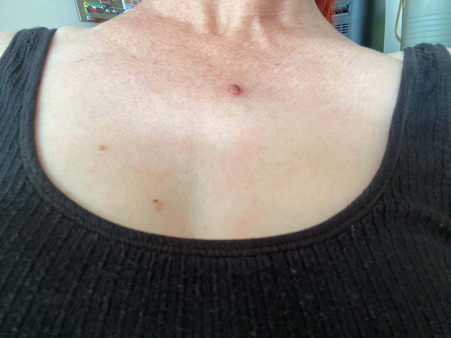 Customer photo review of THE VIRAL SUPER STICK - targets skin tags • keratosis • moles • sun damage • stubborn blemishes