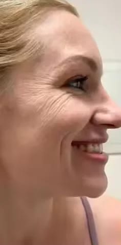 Customer photo review of Micro Infusion Microneedle Kit for Face
