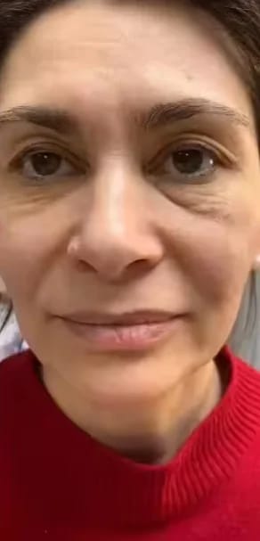 Customer photo review of Micro Infusion Microneedle Kit for Face