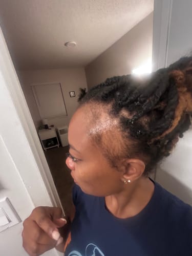Reviewer's side profile showing new baby hairs growing on her temple after using Rennora Hair Growth Serum.