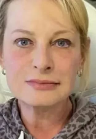 Customer photo review of Micro Infusion Microneedle Kit for Face