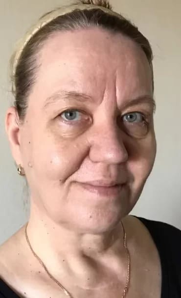Customer photo review of Micro Infusion Microneedle Kit for Face