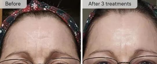 Customer photo review of Micro Infusion Microneedle Kit for Face