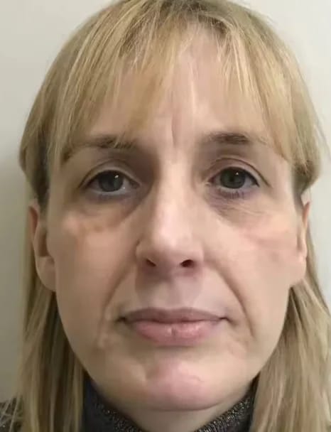 Customer photo review of Micro Infusion Microneedle Kit for Face
