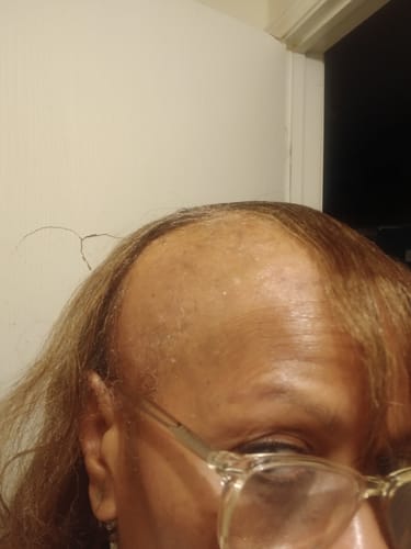 Close-up of a reviewer's thinning hairline showing new hair fuzz after using Rennora Hair Growth Serum.
