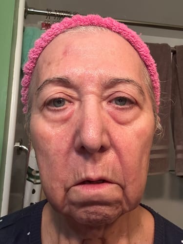 A reviewer's face showing wrinkles and skin texture before trying the Seranova Micro Infusion System.