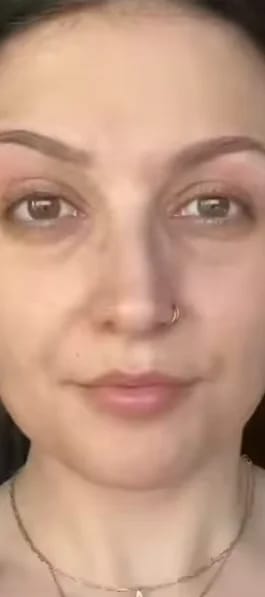 Customer photo review of Micro Infusion Microneedle Kit for Face