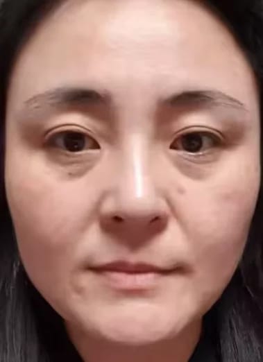 Customer photo review of Micro Infusion Microneedle Kit for Face