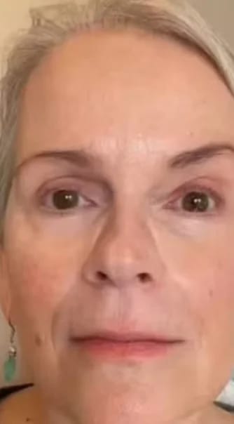 Customer photo review of Micro Infusion Microneedle Kit for Face