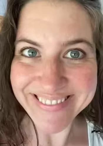 Customer photo review of Micro Infusion Microneedle Kit for Face