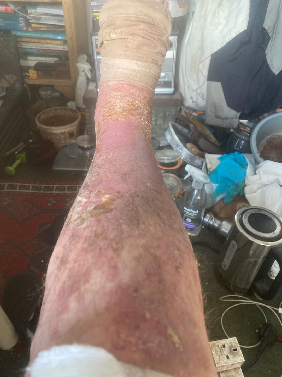 Customer photo review of Bioskin Zeoderm Skin Repair Moisturiser