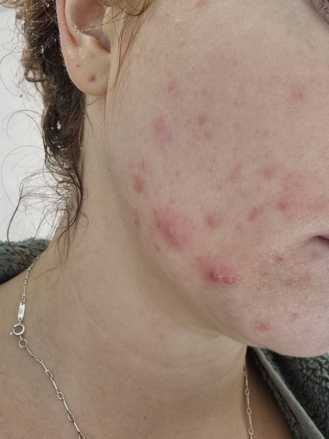 Customer photo review of Clear · Skin Treatment – ZAP Formula - 50ml