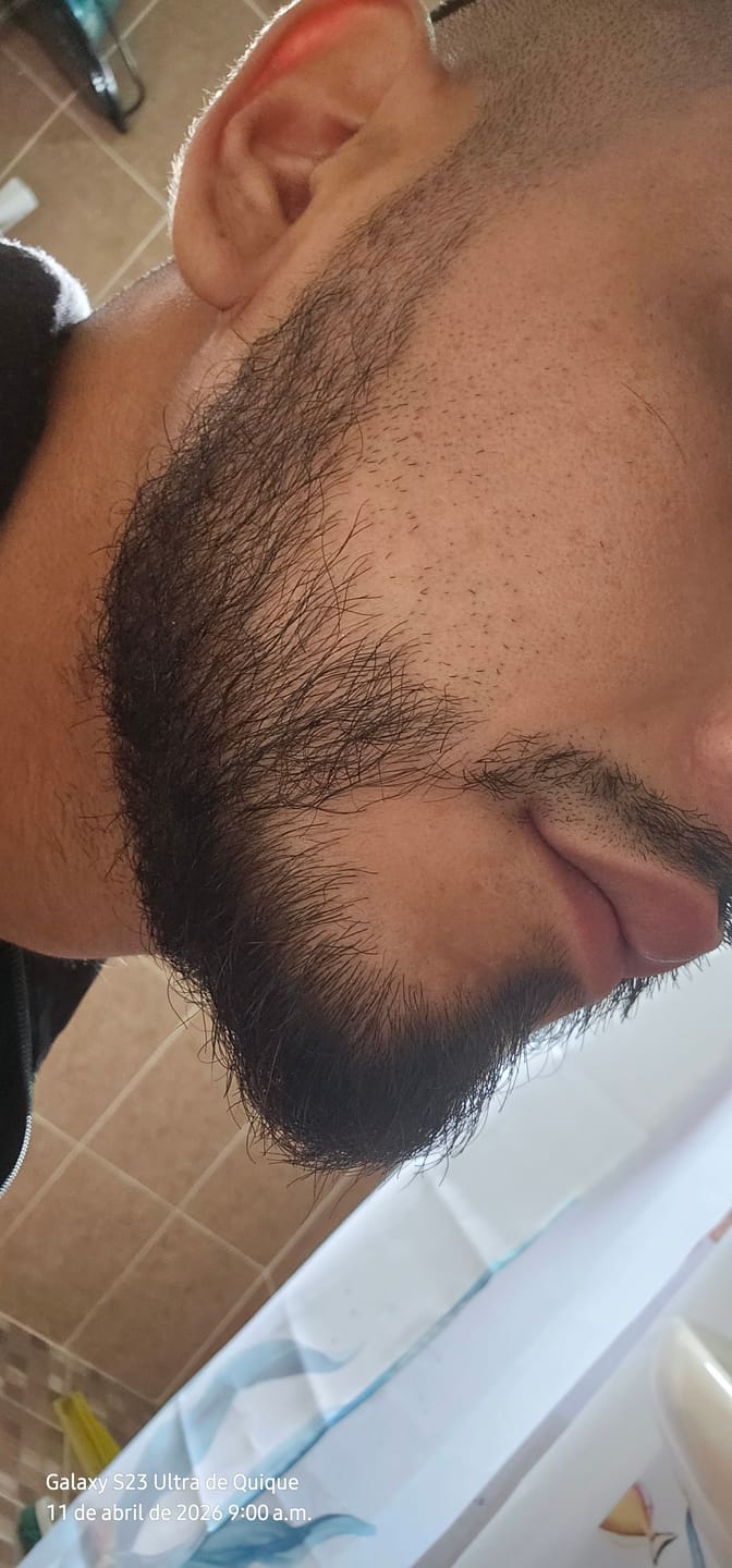 Customer photo review of Kit Barba Real | 2 Minoxidil al 20% +Biotina + Derma | El kit más Completo para crecimiento de Barba