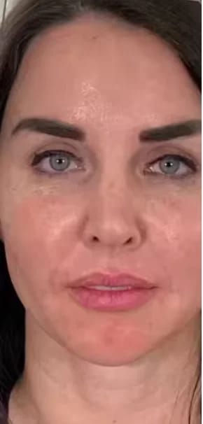 Customer photo review of Micro Infusion Microneedle Kit for Face
