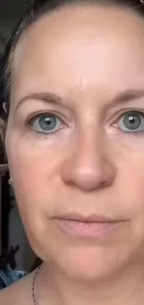 Customer photo review of Micro Infusion Microneedle Kit for Face