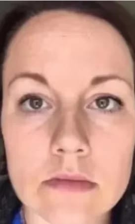 Customer photo review of Micro Infusion Microneedle Kit for Face