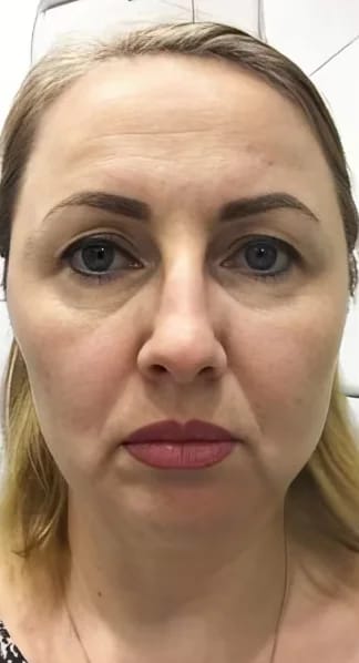 Customer photo review of Micro Infusion Microneedle Kit for Face