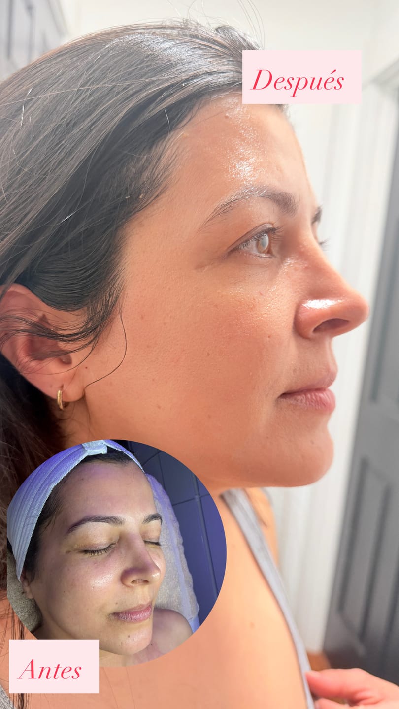 Customer photo review of Bravity Skin Reboot Spicule Serum