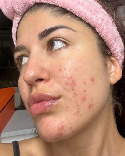 Customer photo review of Crema al collagene coreano | Pelle Pelle Pulita in 7 giorni