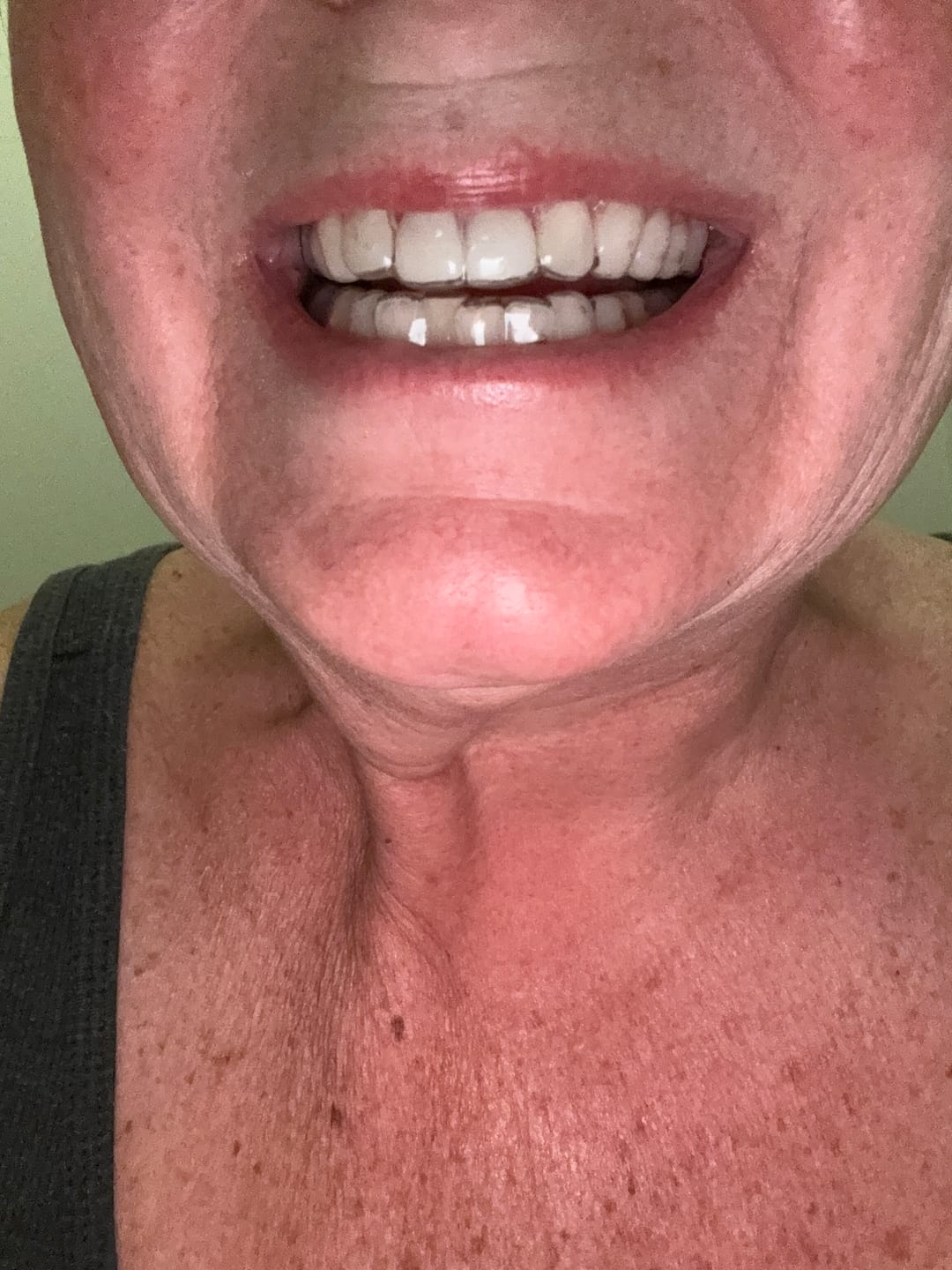 Customer photo review of Clear Custom Night Guard
