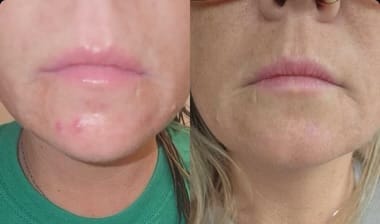 Customer photo review of Crema al collagene coreano | Pelle Pelle Pulita in 7 giorni