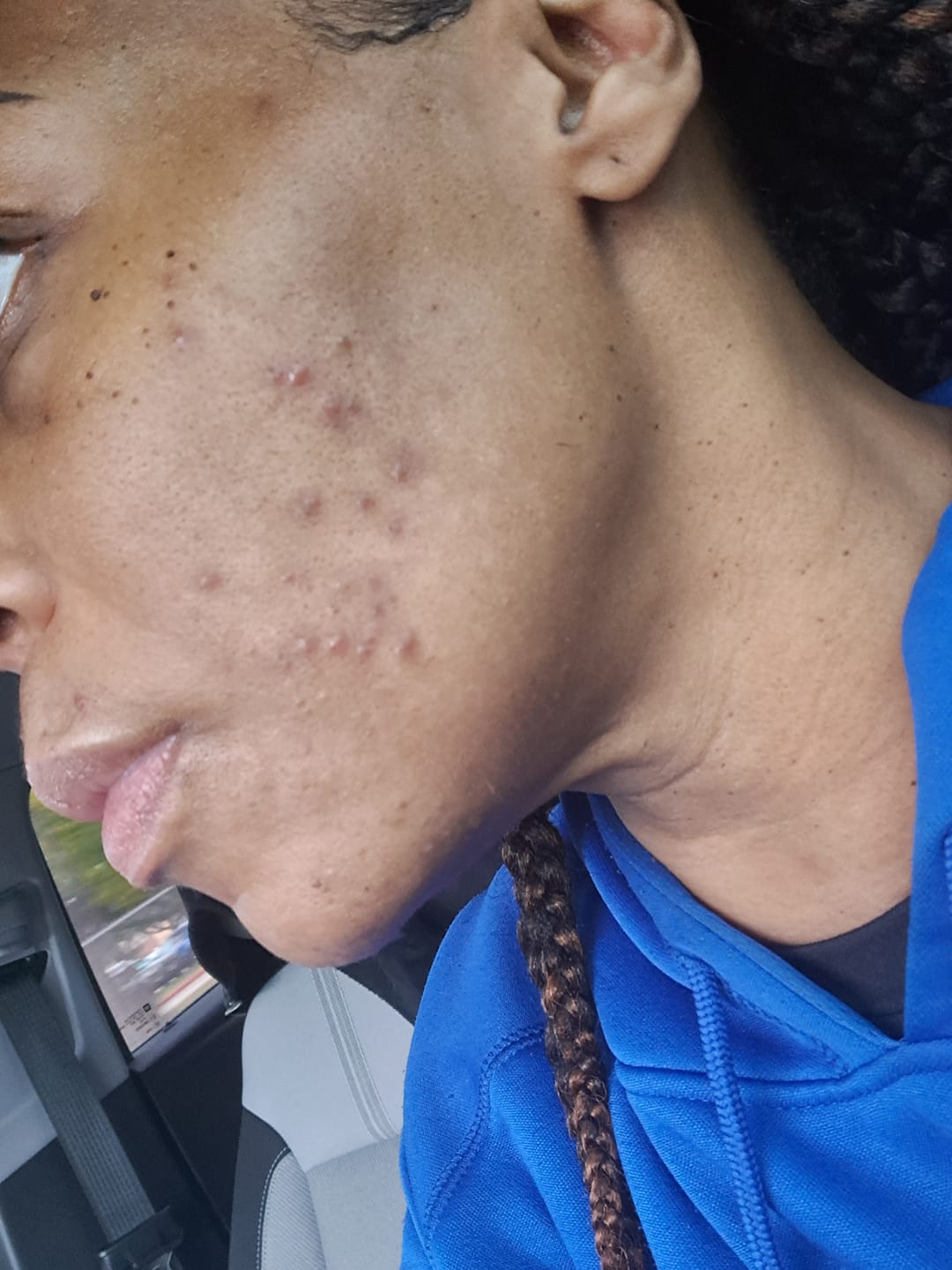 Customer photo review of Target Area Cream