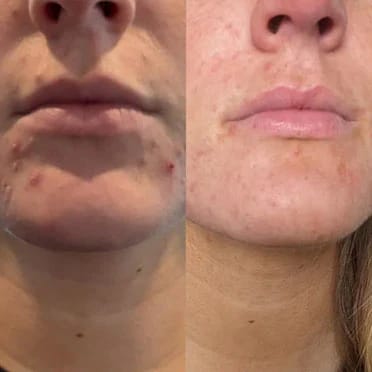 Customer photo review of Crema al collagene coreano | Pelle Pelle Pulita in 7 giorni