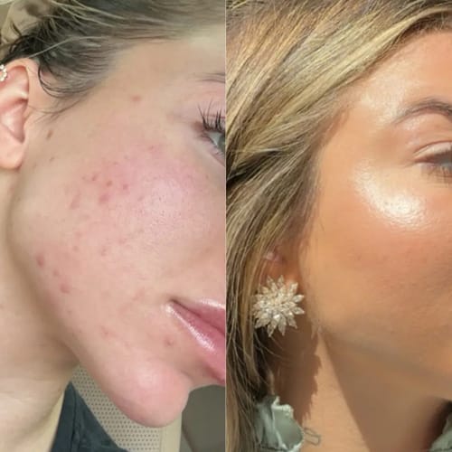 Customer photo review of Crema al collagene coreano | Pelle Pelle Pulita in 7 giorni
