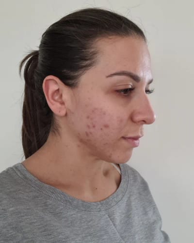 Customer photo review of Crema al collagene coreano | Pelle Pelle Pulita in 7 giorni