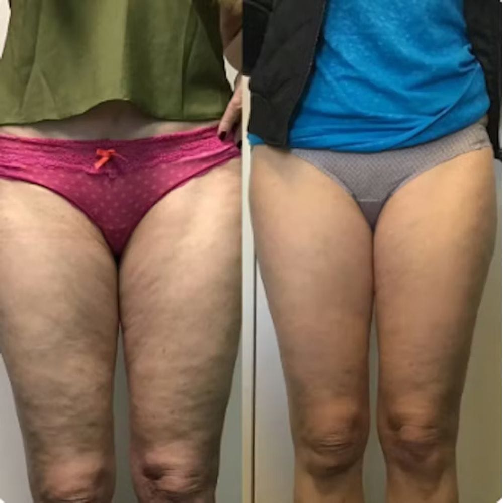 Customer photo review of Cellugone 3.0: Glättet Cellulite und strafft Bauch, Beine & Po für zuhause