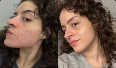 Customer photo review of Crema al collagene coreano | Pelle Pelle Pulita in 7 giorni