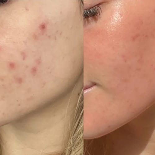 Customer photo review of Crema al collagene coreano | Pelle Pelle Pulita in 7 giorni