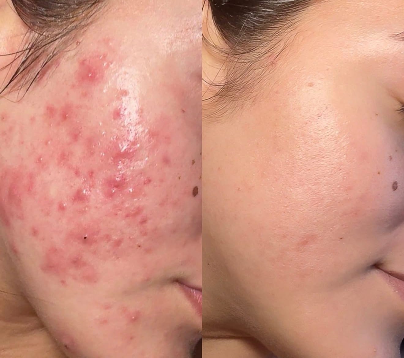 Customer photo review of A CONTROL - ACNÉ HORMONAL & RESISTENCIA A LA INSULINA
