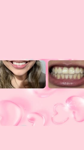 Customer photo review of Tiras Blanqueadoras VITTÉ Pack 14 días