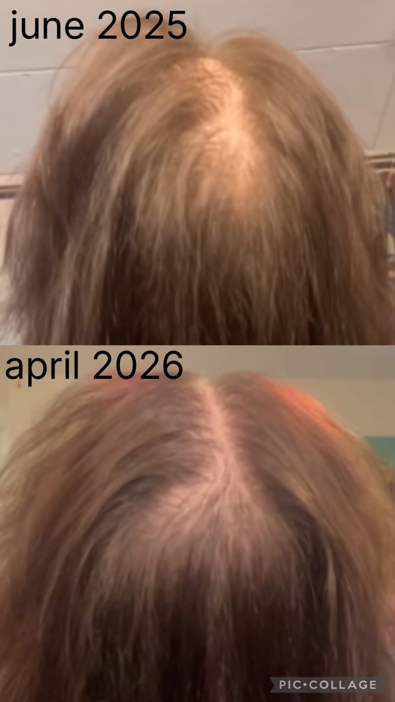Customer photo review of Hair Loss Prevention Kit