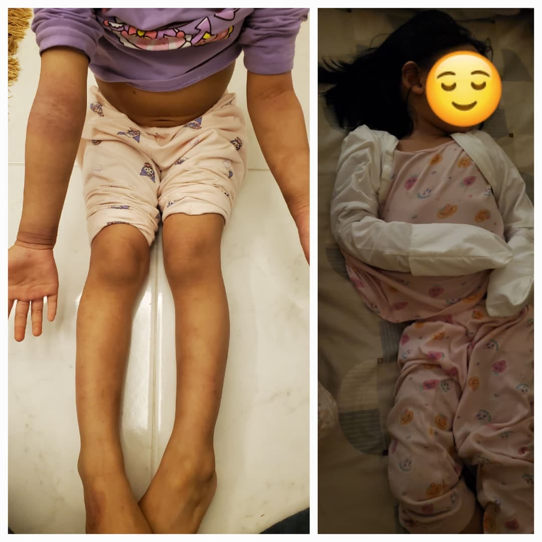 Customer photo review of Eczema Scratch Mitten