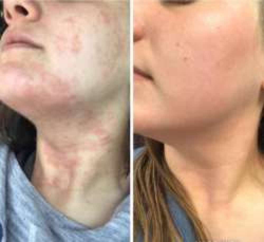 Customer photo review of Smiles & Joys Eczema and Psoriasis Herbal Cream